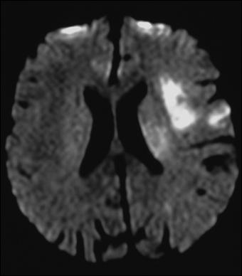6.3. Schlaganfalldiagnostik 89 Abbildung 6.12: Ein diffusionsgewichtetes MR-Bild zeigt das vom Schlaganfall betroffene Gewebe. Der helle Bereich weist auf einen Infarkt hin.