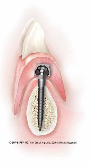 Langfristige Fixation von Einzelkronen Minimalinvasives Vorgehen Häufig kein Knochenaufbau notwendig In der Regel Sofortbelastung im Unterkiefer möglich Kosteneffizient für die Zahnarztpraxis