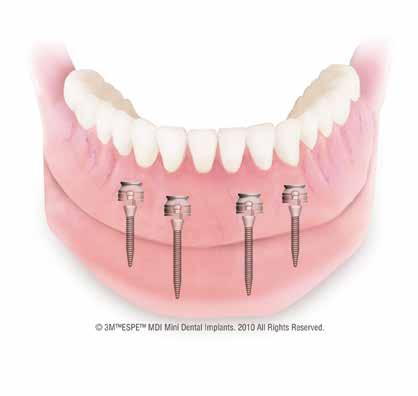 klassische Implantate finanziellen Einschränkungen 3M ESPE MDI Mini-Dental-Implantate und Zubehörteile werden in Deutschland, Österreich und der Schweiz ausschließlich direkt von 3M ESPE vertrieben.