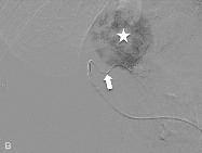 C Abbildung 3: A: Funktionsprinzip der Chemo-/Radioembolisation: Mikrosphären (rote Punkte) beladen mit 90Y oder Chemotherapeutikum werden in der Nähe des Tumors (Stern) u ber einen Mikrokatheter