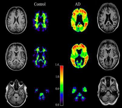 Wahrscheinlichkeit Dementielle Symptome, wahrscheinlich nicht durch Alzheimer Pathologie mittel positiv nicht untersucht Amyloid-PET nicht untersucht positiv hoch positiv positiv niedrig negativ