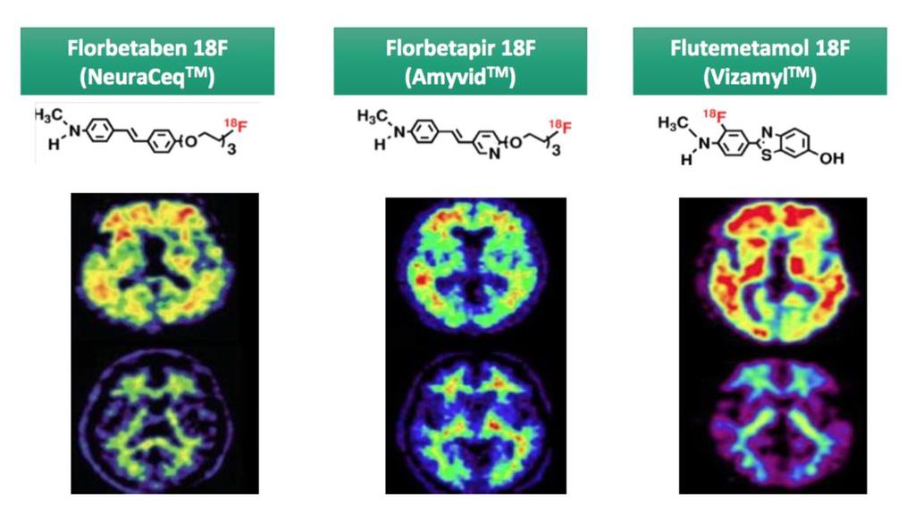 Positronenemmissionstomographie des Gehirns β- Amyloid PET Zugelassene Tracer in USA und EU Patienten mit Alzheimer-