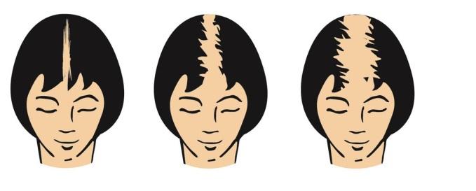 Die Behandlung mit Alocutan 20 mg/ml fördert das Haarwachstum und wirkt dem Fortschreiten der androgenetischen Alopezie entgegen.