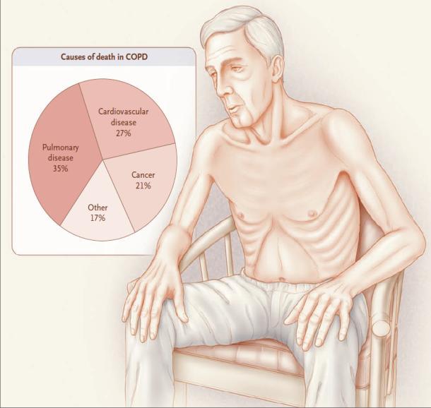 COPD UND HERZPROBLEME 50 % der Patienten, die an COPD leiden, haben eine Koronarerkrankung, arteriellen Bluthochdruck oder eine Herzinsuffizienz.