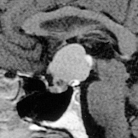 1.3 Allgemeine Diagnostik 9 1.. Abb. 1.4 Supraselläres, zystisches Kraniopharyngeom als ausschließlich extrasellärer Tumor bei normal großer Sella turcica (T1 gewichtete MRT in sagittaler Schnittführung).