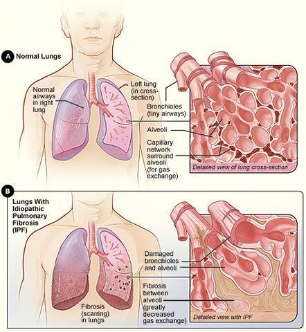 Idiopathische Lungenfibrose Chronische, fortschreitende interstitielle Lungenerkrankung Gesteigerte Produktion und Anreicherung von
