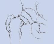 Die Endoprothese besteht aus der Hüftpfanne und dem Hüftschaft, auf den ein Kugelkopf aufgesetzt wird, der sich in der Pfanne bewegt.