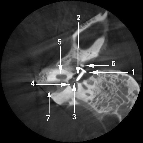 Abb. 17: Darstellung der Keramikprothese.