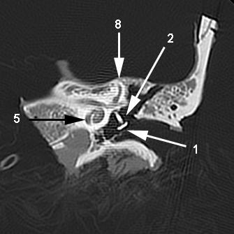 des CT (1 Prothesenteller; 2 Prothesenschaft; 3 Basis stapedis; 4