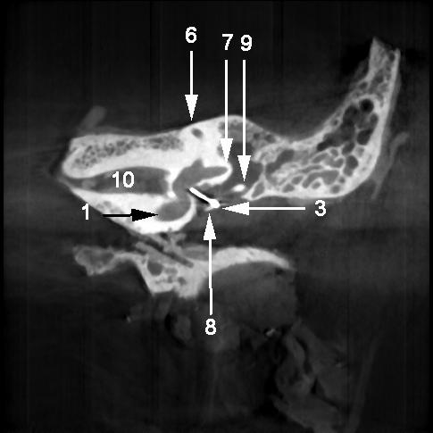 rechts die des CT (1 Cochlea; 2 Vestibulum; 3 Platin-Teflon