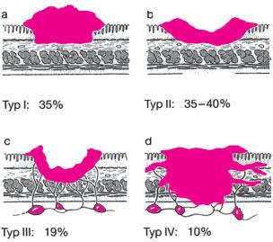 Magenausgangsstenose) Diagnostik zum Nachweis von Metastasen (Staging): CT des Abdomens mit Kontrastmittel: Nachweis von Lymphknoten- und Organmetastasen Röntgen-Thorax: Nachweis von pulmonalen