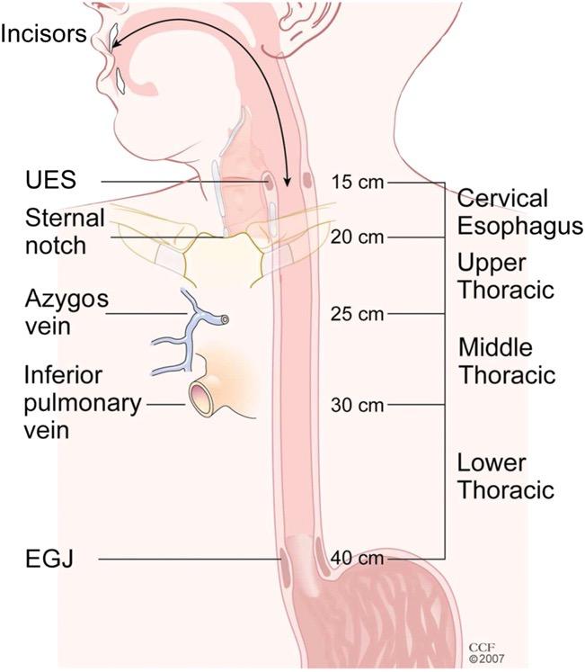 klassifiziert. Demgegenüber werden alle anderen Tumore, deren Epizentrum im Magen in einem Abstand von mehr als 5 cm zum ösophagogastralen Übergang gelegen sind bzw.