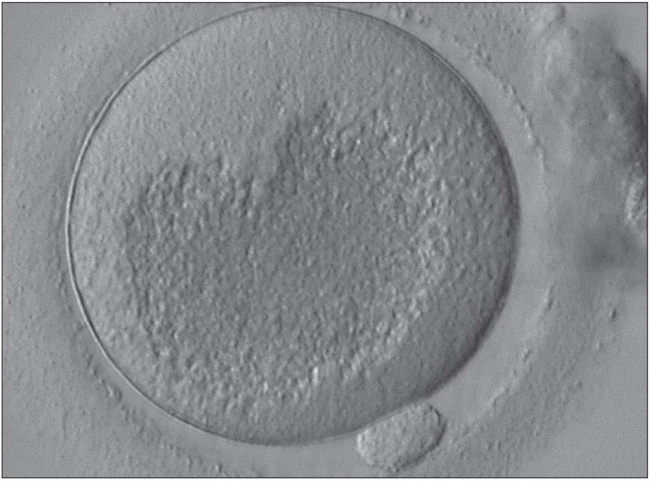 Abbildung 3: MII-Eizelle mit stärkstem Zentralgranula. Abbildung 5: Oozyte mit dominantem refraktilem Körper. Abbildung 4: Reifer Gamet mit vier größeren und zwei kleineren Inkorporationen.
