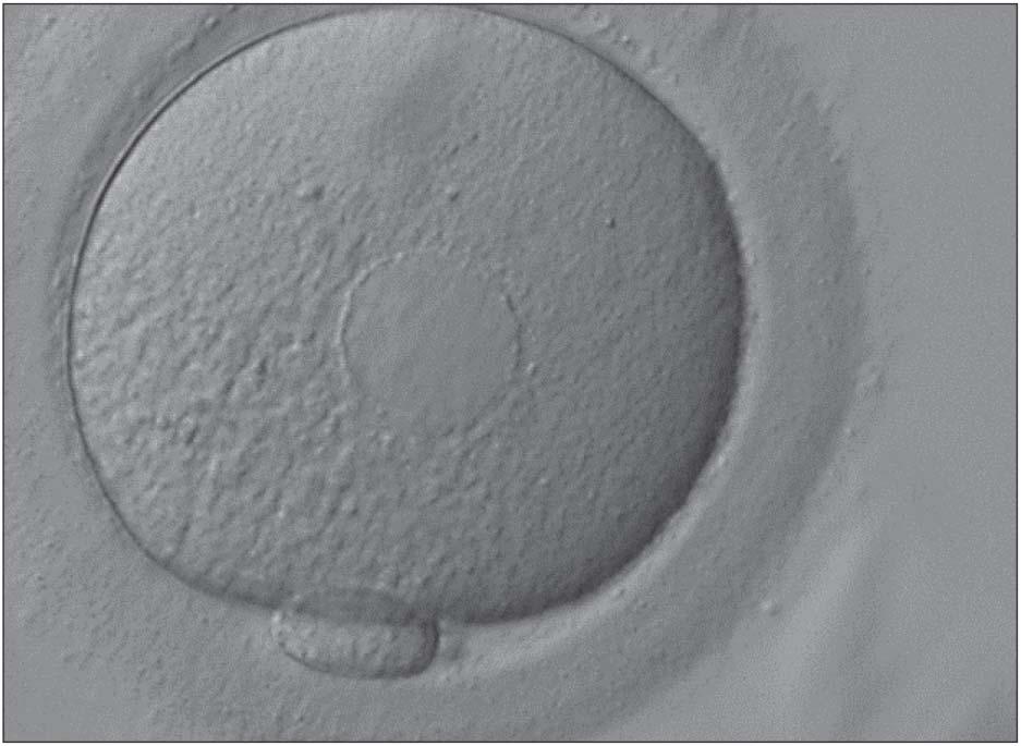 Abbildung 7: MII-Eizelle mit einer zentralen Aggregation des glatten endoplasmatischen Retikulums. Abbildung 9: Ovale Eizelle, deren innere Zonaschicht sich abgelöst hat.