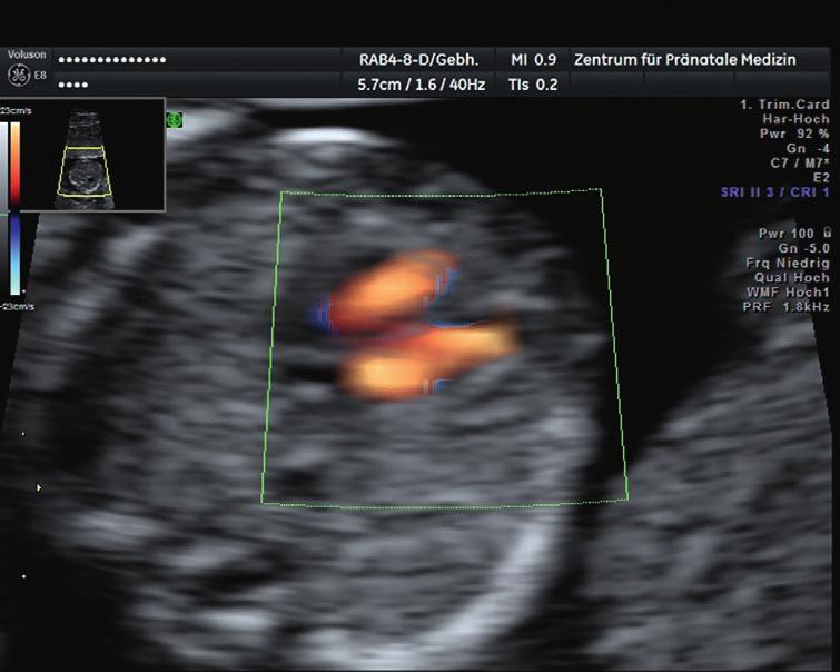 Abb. 2. Farb-Ultraschall der beiden Herzkammern (13.