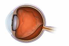 Das Auge weist eine anhaltende Adhäsion des Glaskörpers an der Makula auf vitreomakuläre Traktion vitreomakuläre Adhäsion Diese Teile mit vitreomakulärer Adhäsion können eine Zugspannung auf die
