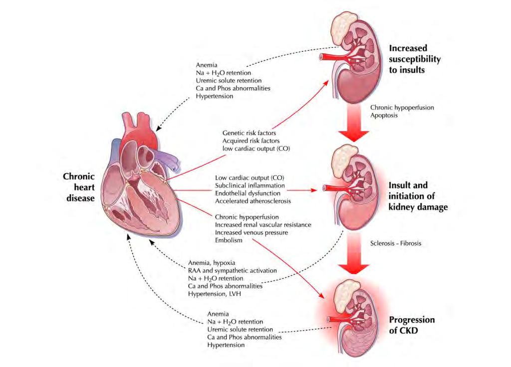 Klassifikation des kardiorenalen Syndroms Typ I cardiorenal Typ II cardiorenal Typ III renocardial Typ IV renocardial Typ V cardial/renal akute kardiale Dekompensation und sek.