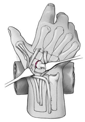 Abbildung 4 Queres Eröffnen der Handgelenkkapsel in ihrem radialen Anteil. Darstellen der sowie Inspektion des proximalen Fragments und des skapholunären Bandes.