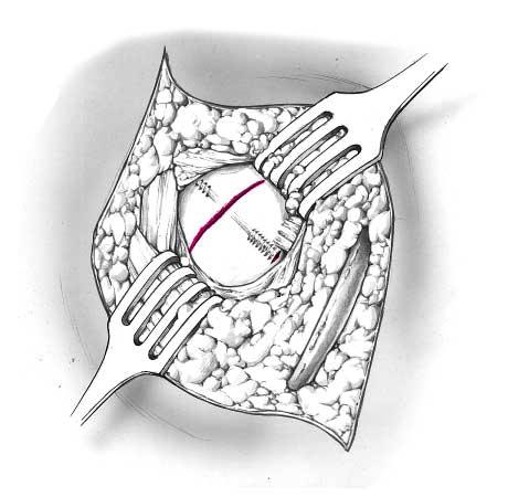 Capsula articularis Abbildung 5 In Freihandtechnik von proximal Vorbereiten des Schraubenkanals mit Gleitlochbohrer, Gewindelochbohrer