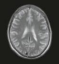 Einige andere Krankheiten, die durch die MRT nachweisbar sind, können nämlich ähnliche Veränderungen hervorrufen. Abb. 9a: MRT-Aufnahme des Gehirns eines gesunden Menschen. Abb. 9b: MRT-Aufnahme des Gehirns eines Menschen mit MS.