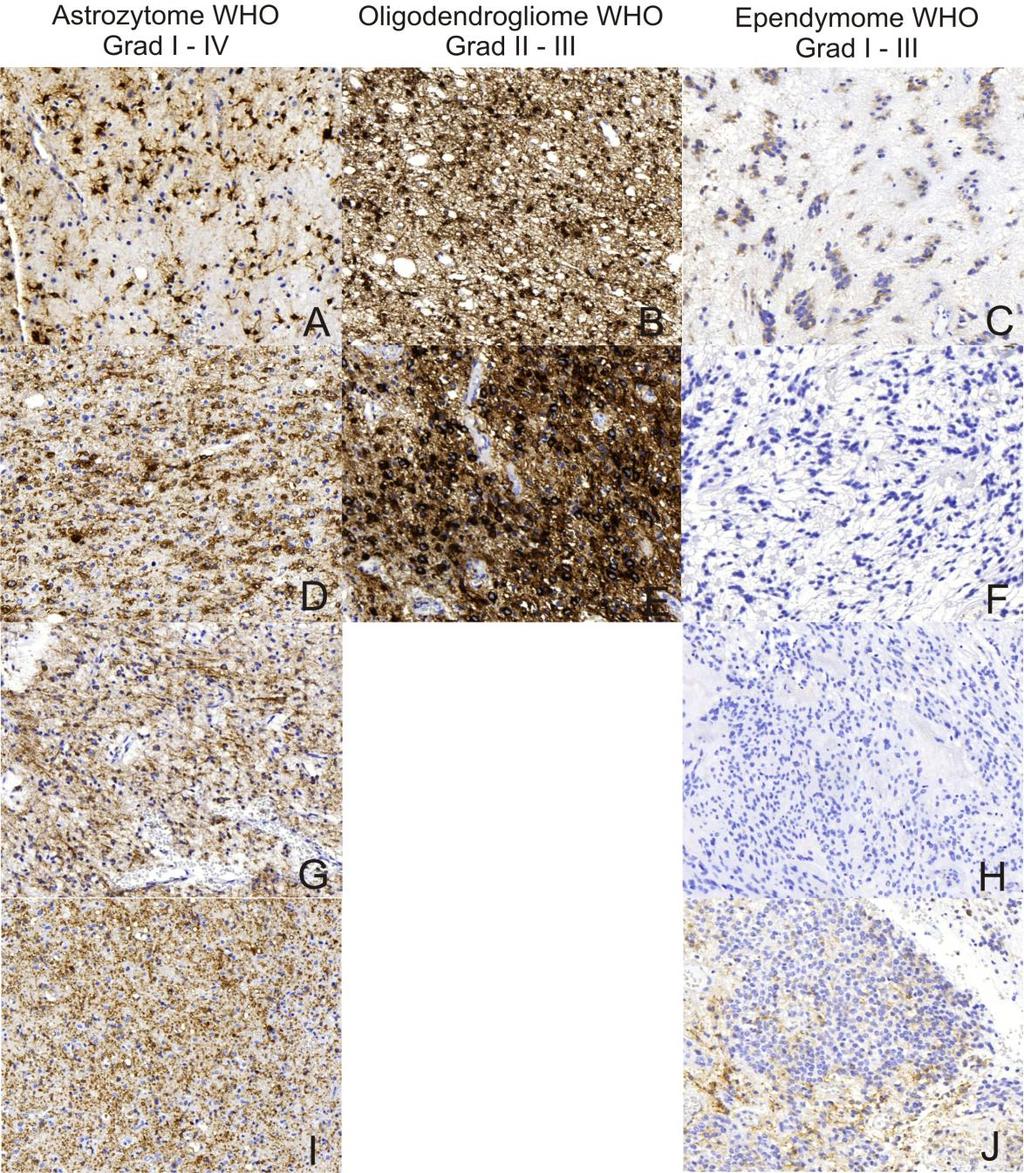 Ergebnisse 66 Abbildung 12: Immunhistochemische MAP 2 Expression der Tumorentitäten. A: Pilozytisches Astrozytom WHO Grad I mit mittlerer Expression.