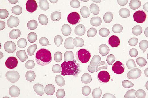 Teil 2 Leitsymptome von Krankheiten Abbildung 81e-46 Chronische lymphatische Leukämie im peripheren Blut.