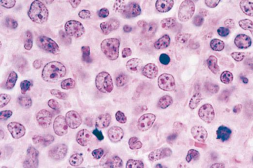 Lymphozyten mit häufigen zerebriformen Zellkernen (Sézary-Zellen) bei einem Patienten mit fortgeschrittener Mycosis