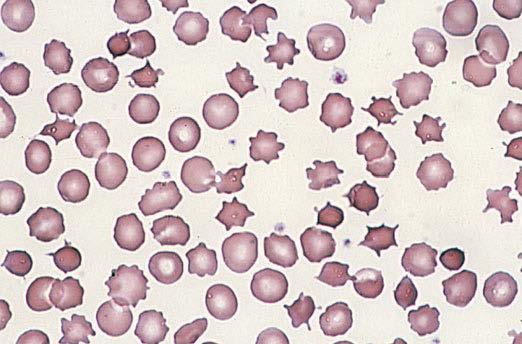 Eine höhere Anzahl an Targetzellen ist typisch bei der Hämoglobin-C-Erkrankung. Abbildung 81e-16 Akanthozytose. Erythrozyten mit spitzen Ausläufern.