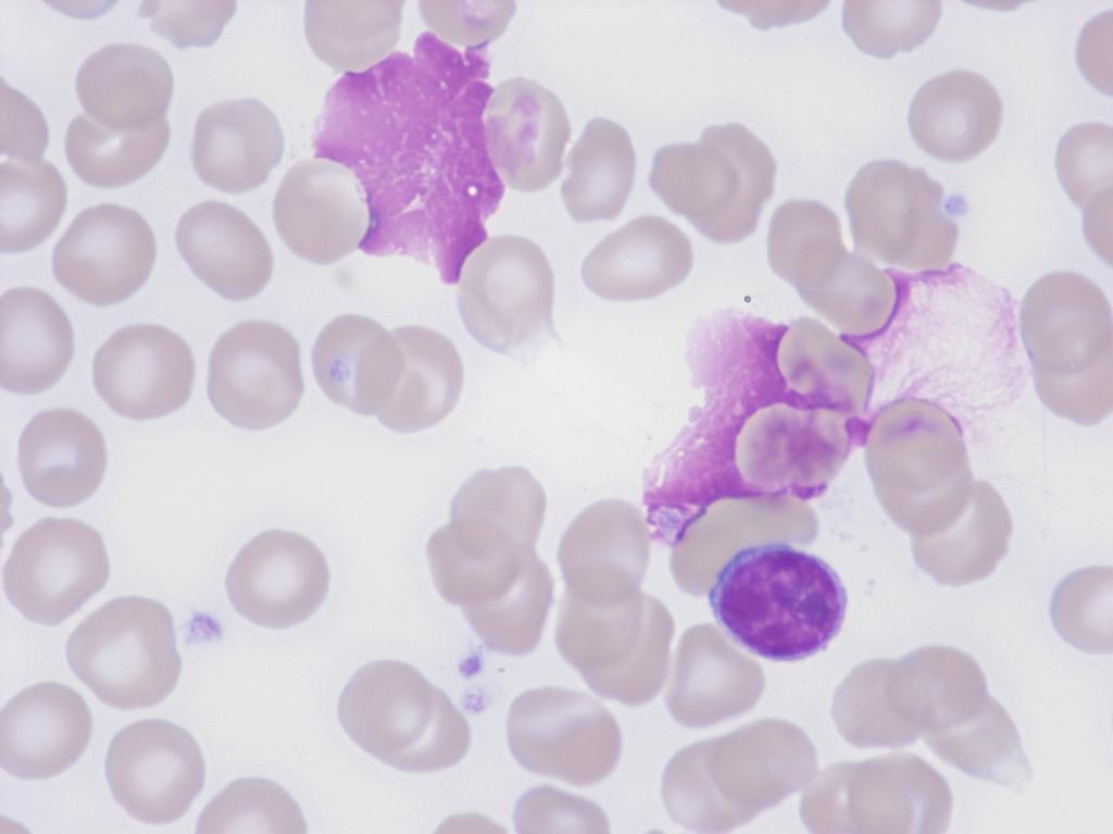 RfB Ringversuch DF2/12 Differentialblutbild Diagnose Ausstrich A: Lymphom