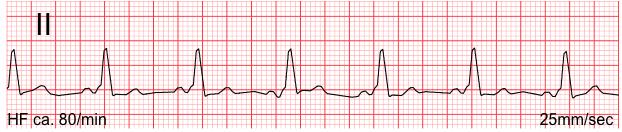 Im EKG ist sowohl der vorzeitige Erregungsbeginn im Ventrikel als auch die initial langsame Ausbreitungsgeschwindigkeit zu erkennen: Die Strecke zwischen P-Welle und Kammerkomplex ist auffallend