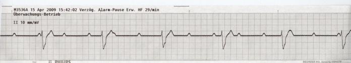 AV-Block III Auch diese Rhythmusstörung wurde schon mehrfach erwähnt und soll daher an dieser Stelle nur kurz wiederholt werden.
