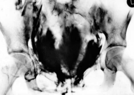 Urethrozystographie bei mehrfragmentären ventralen Frakturen Blutige Anurie oder
