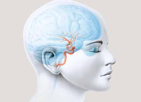 ZENTRUM FÜR NEURORADIOLOGIE NEUROVASKULÄRE ERKRANKUNGEN DAS ZENTRUM FÜR NEURORADIOLOGIE DER KLINIK HIRSLANDEN BIETET BILDGEBENDE ABKLÄRUNG UND