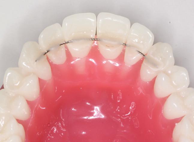 WIE LANGE MÜSSEN RETAINER GETRAGEN WERDEN? Die Länge der Retentionsphase hängt von der Art und Umfang der erfolgten Zahnbewegung ab. Sie wird für jeden Patienten individuell festgelegt.