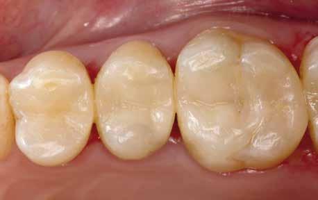 Diese erleichtert die Reproduktion des natürlichen Zahnes und schafft zudem im Dentin- und Schmelzbereich einen ausbalancierten Chamäleoneffekt.