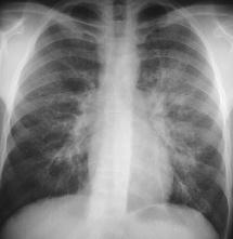 c Eine Verdichtung ist eindeutig als pulmonal identifizierbar und von einer pleuralen Ursache zu unterscheiden durch den Nachweis eines Luftbronchogramms.