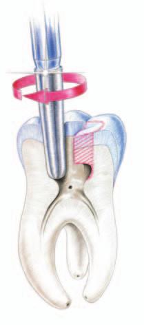 WISSENSCHAFT Laser in der Endodontie eine praktische Übersicht Abb.
