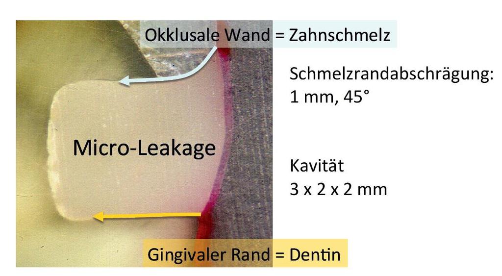 Abb. 42 Klasse-V-Kavität für die Prüfung auf Mikroundichtigkeiten (Rosales Leal, J. I.) Die Farbstoffpenetration wurde als Gesamtlänge der Undichtigkeit entlang der Dentin- bzw.