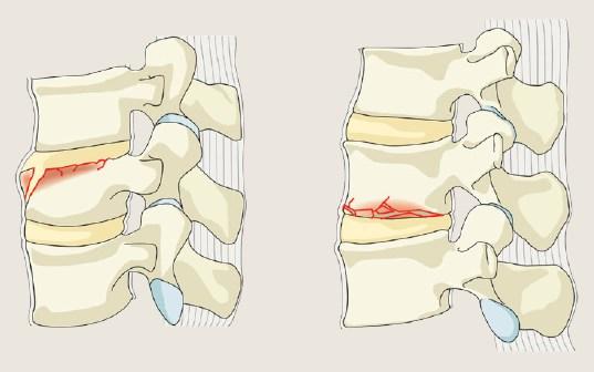 Subtyp A0: Infraktions- und/oder Fortsatzbruch Darunter fallen neben Frakturen der Dorn- und Querfortsätze auch unvollständige Knochenbrüche im Bereich des Wirbelkörpers,