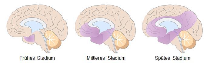 Kapitel 2: Medizinische Sicht auf die Demenz im jüngeren Lebensalter 9 /21 2.4 Betroffene Regionen des Gehirns Der Nervenzellverlust beginnt meist im Schläfenlappen einschließlich des Hippokampus.