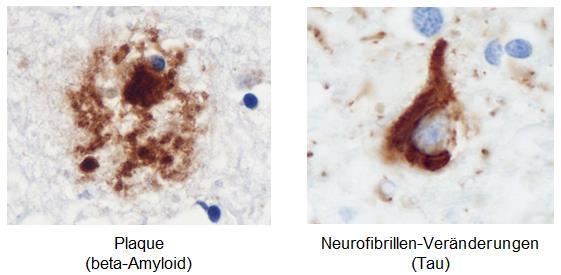 5 Betroffene Regionen des Gehirns bei der Alzheimer-Krankheit 2.5 Feingewebliche Veränderungen Abb.