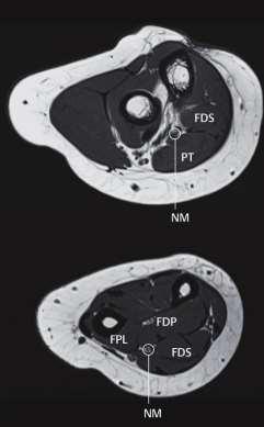 N. medianus - MRT-Anatomie Am Oberarm zwischen M.