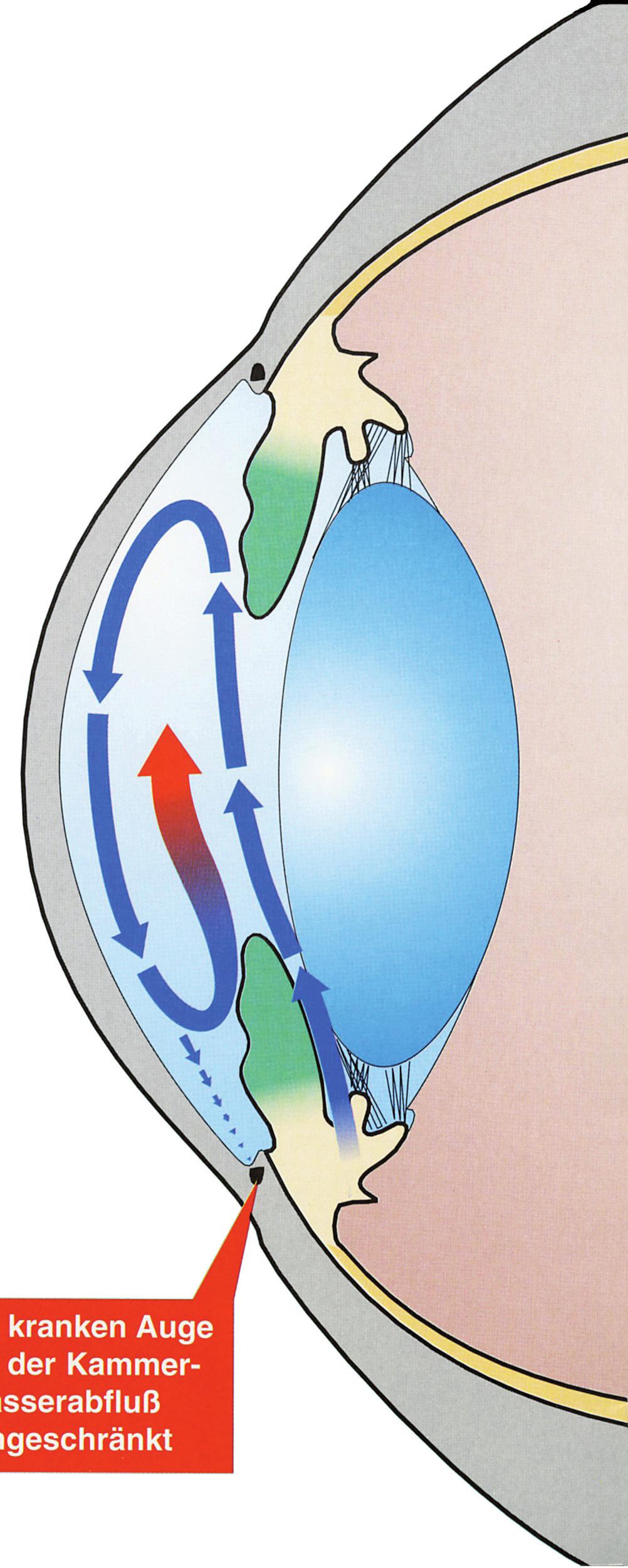 Was ist ein Glaukom? Ein Glaukom ist eine Augenerkrankung, die meist mit einem erhöhten Augeninnendruck einhergeht. Die Erhöhung wird durch eine Behinderung des Kammerwasserabflusses ausgelöst.