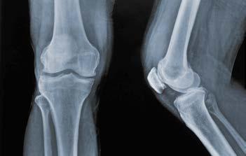 Normales Kniegelenk Athrosegelenk Ursachen für die Abnutzung sind häufig altersbedingt, ein übermäßiger Verschleiß entsteht aber auch durch Fehlstellungen (z.b. X- oder O Bein-Stellung), Entzündungen oder vorausgegangenen Verletzungen z.
