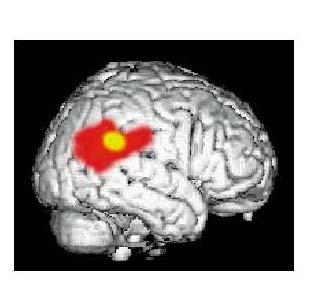 Visual neglect: visual awareness is lost even when primary visual cortex & affarent inputs are intact Patients have deficient awareness for stimuli towards contralesional (mostly) left side of space;