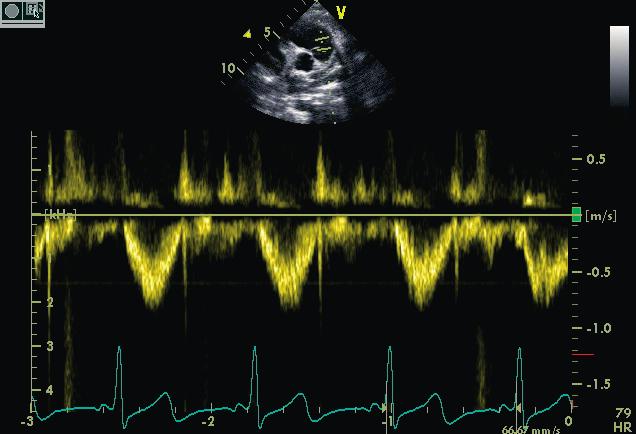 Bild 20 Doppler Pulmonalklappe Was wir messen: Zeitmarker Klappenöffnung