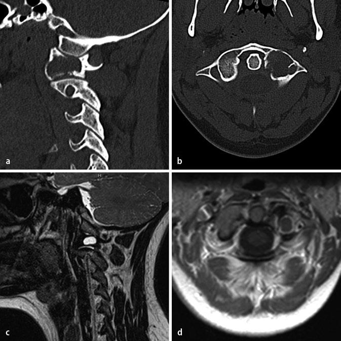 Kasuistiken Abb. 1 8 Zystische Veränderung mit synovialer Auskleidung der linken Massa lateralis, sowie Infraktion des oberen und unteren Facettengelenks: a CT der HWS; sagittale Schnittbildebene.