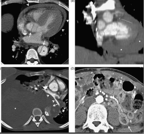 Aortendissektion Suche nach Komplikationen -Ruptur -hämorrhagischer Pleura- oder