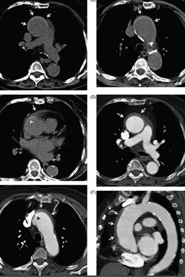 Intramurales Hämatom Natives CT: verdickte Aortenwand mit erhöhter Dichte Im KM CT: Verwechslung mit