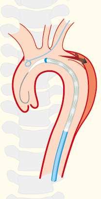 Typ-B Aortendissektion Klinischer Verlauf Progredienz des Aorten- durchmessers Kompression des wahren Lumens Verlegung
